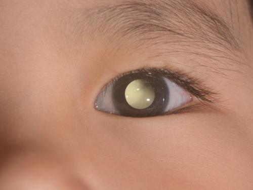 child's eye with white circle showing signs of retinoblastoma
