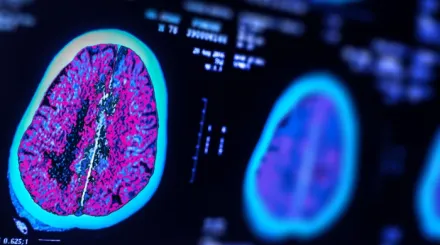 A scan of a brain