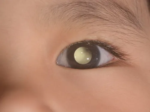 child's eye with white circle showing signs of retinoblastoma